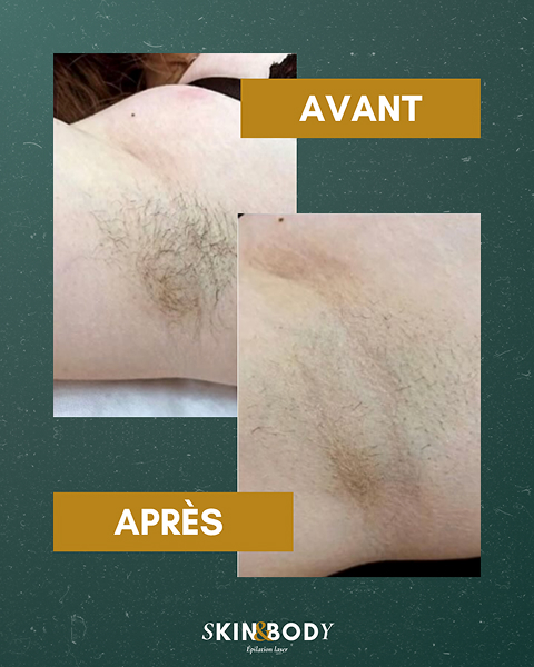 Des résultats visibles et durables Résultat avant après épilation laser des aisselles
